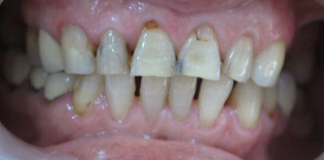 Teeth Extractions Procedure at Opal Dental Care Studio by Dr. Aastha Chandra at Juhu, Mumbai.