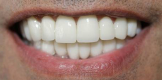 Invisible Aligners at Affordable Rates by Dr. Aastha Chandra in Opal Dental Care Studio