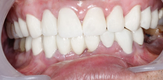 Affordable Gum Depigmentation Procedures at Opal Dental Care Studio in Mumbai - Dr. Aastha Chandra