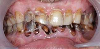 Affordable Gum Depigmentation Procedures at Opal Dental Care Studio in Mumbai - Dr. Aastha Chandra