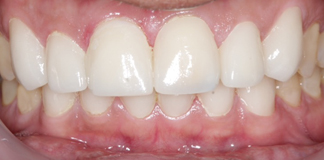 Full Mouth Rehabilitation Procedure at Opal Dental Care Studio in Mumbai - Dr. Aastha Chandra