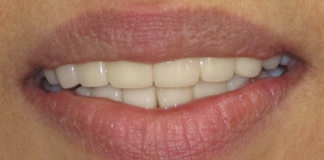 Smile Designing Before And After Image By Dr. Aastha Chandra