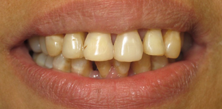 Smile Designing Before And After Image By Dr. Aastha Chandra