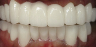 Full Mouth Dental Implants & Crowns Treatment By Dr. Aastha Chandra For International Patients.
