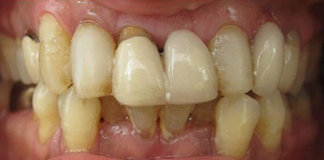 Full Mouth Dental Implants & Crowns Treatment By Dr. Aastha Chandra For International Patients.