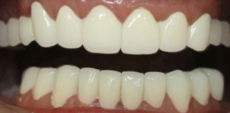 Full Mouth Dental Restoration Using Dental Crowns And Veneers By Dr. Aastha Chandra