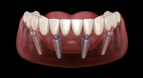 Dental Titanium Implant 