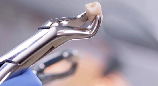 Best Wisdom Tooth Removal Dentist in Mumbai