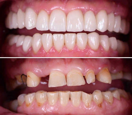 Decayed & Missing Teeth Treatment