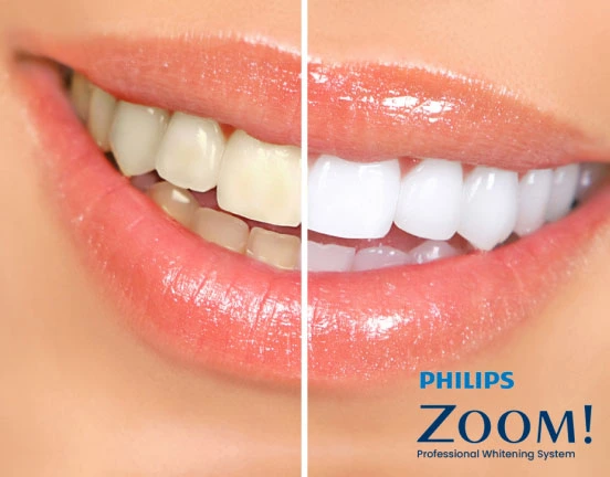Before and After Instant Teeth Whitening Treatment - Dr. Aastha Chandra