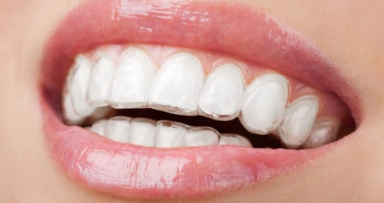 Affordable and Best Invisible Braces for Adults in Mumbai