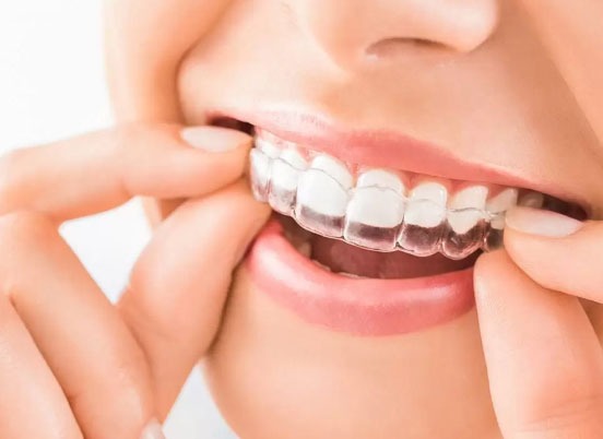 Invisalign Clear Aligners 