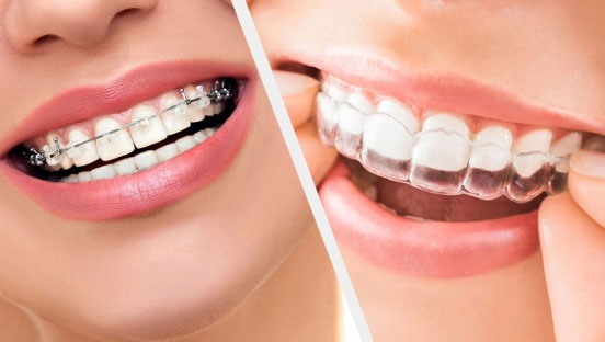 Best Orthodontic Treatment in Mumbai - Opal Dental Care Studio