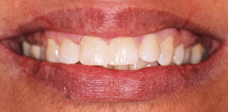 Chipped And Broken Teeth Treatment By Dr. Aastha Chandra At Opal Dental Care Studio