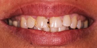 Chipped And Broken Teeth Treatment By Dr. Aastha Chandra At Opal Dental Care Studio