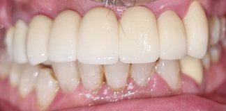 Crowns And Bridges Replaced By Dr. Aastha Chandra At Opal Dental Care Studio