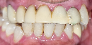 Crowns And Bridges Replaced By Dr. Aastha Chandra At Opal Dental Care Studio