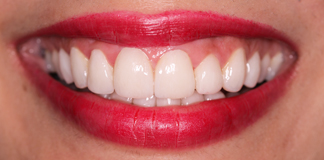 Hollywood Smile By Dr. Aastha Chandra At Opal Dental Care Studio