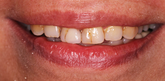Stained Teeth Treatment By Dr. Aastha Chandra At Opal Dental Care Studio