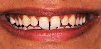 Gaps In Teeth Treatment By Dr. Aastha Chandra At Opal Dental Care Studio