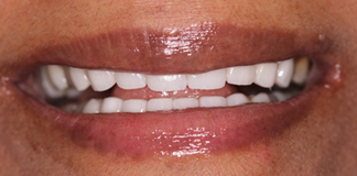 Full Mouth Reconstruction Using Dental Implants And Crowns By Dr. Aastha Chandra At Opal Dental Care Studio