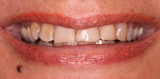 Full Mouth Reconstruction By Dr. Aastha Chandra