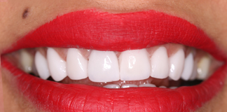Smile Designing Using Porcelain Veneers By Dr. Aastha Chandra At Opal Dental Care Studio