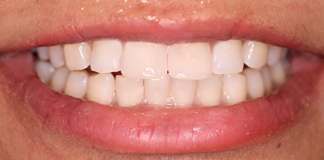 Broken And Chipped Teeth Treatment By Dr. Aastha Chandra At Opal Dental Care Studio