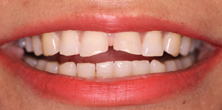 Broken And Chipped Teeth Treatment By Dr. Aastha Chandra At Opal Dental Care Studio