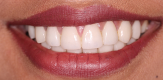 Before And After Smile Makeover Pictures By Dr. Aastha Chandra At Opal Dental Care Studio