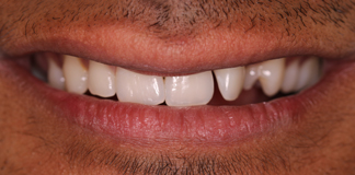 Crooked Teeth Treatment By Dr. Aastha Chandra At Opal Dental Care Studio