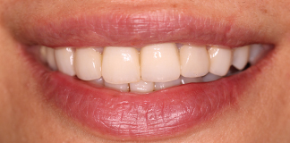 Before and After Extractions by Dr. Aastha Chandra in Juhu, Mumbai - Opal Dental Care Studio