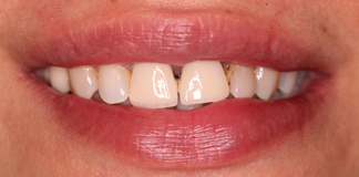 Before and After Extractions by Dr. Aastha Chandra in Juhu, Mumbai - Opal Dental Care Studio