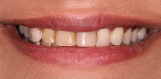 Smile Makeover Using Porcelain Veneers By Dr. Aastha Chandra At Opal Dental Care Studio