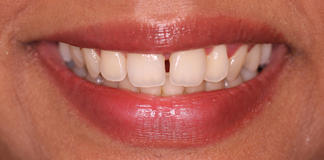 Closing Gaps Between Teeth With Smile Designing And Veneers By Dr. Aastha Chandra At Opal Dental Care Studio
