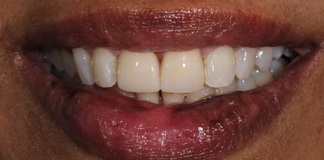 Front Two Teeth Porcelain Veneers Smile Designing By Dr. Aastha Chandra At Opal Dental Care Studio, Mumbai, India.