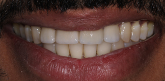 Quick And Affordable Smile Designing Using Four Teeth By Dr. Aastha Chandra At Opal Dental Care Studio, Mumbai, India.