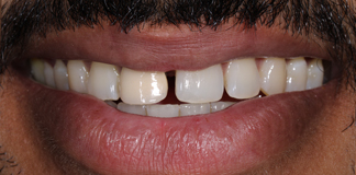 Quick And Affordable Smile Designing Using Four Teeth By Dr. Aastha Chandra At Opal Dental Care Studio, Mumbai, India.