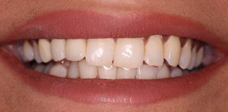 Before And After Image Dental Treatment Done By Dr. Aastha Chandra At Opal Dental Care Studio, Mumbai.