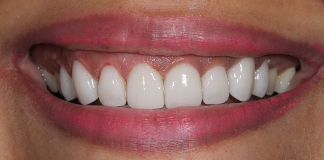 Before And After Image Of A Smile Transformation By Dr. Aastha Chandra At Opal Dental Care Studio, Mumbai, India.