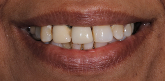 Beautiful & Natural Looking Smile Restoration By Dr. Aastha Chandra At Opal Dental Care Studio.