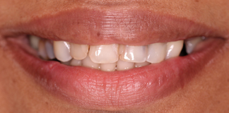 Before And After Image Of A Smile Transformation Using Dental Implants And Crowns By Dr. Aastha Chandra At Opal Dental Care Studio, Mumbai, India