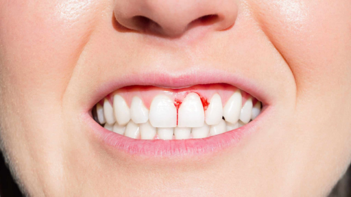 Bleeding Gums
