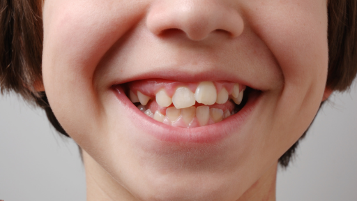 Crooked Teeth