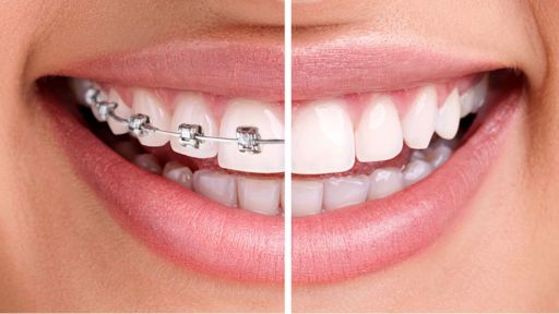 Fix Crooked Teeth Without Braces